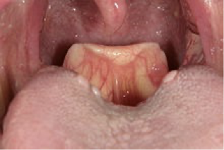 <p>Glottis – opening to the trachea</p><p>Epiglottis – flap of cartilage located behind the tongue that helps prevent food from entering trachea</p><p>Snaps shut when swallowing</p><p></p>