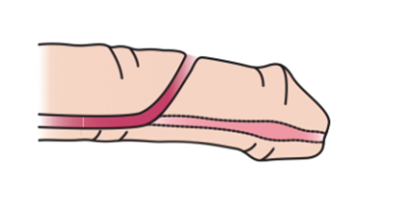 <p>congenital defect in which the urinary meatus is located on the upper surface of the penis</p>