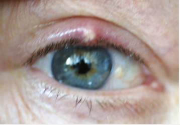 <p>Infection of hair follicle</p>