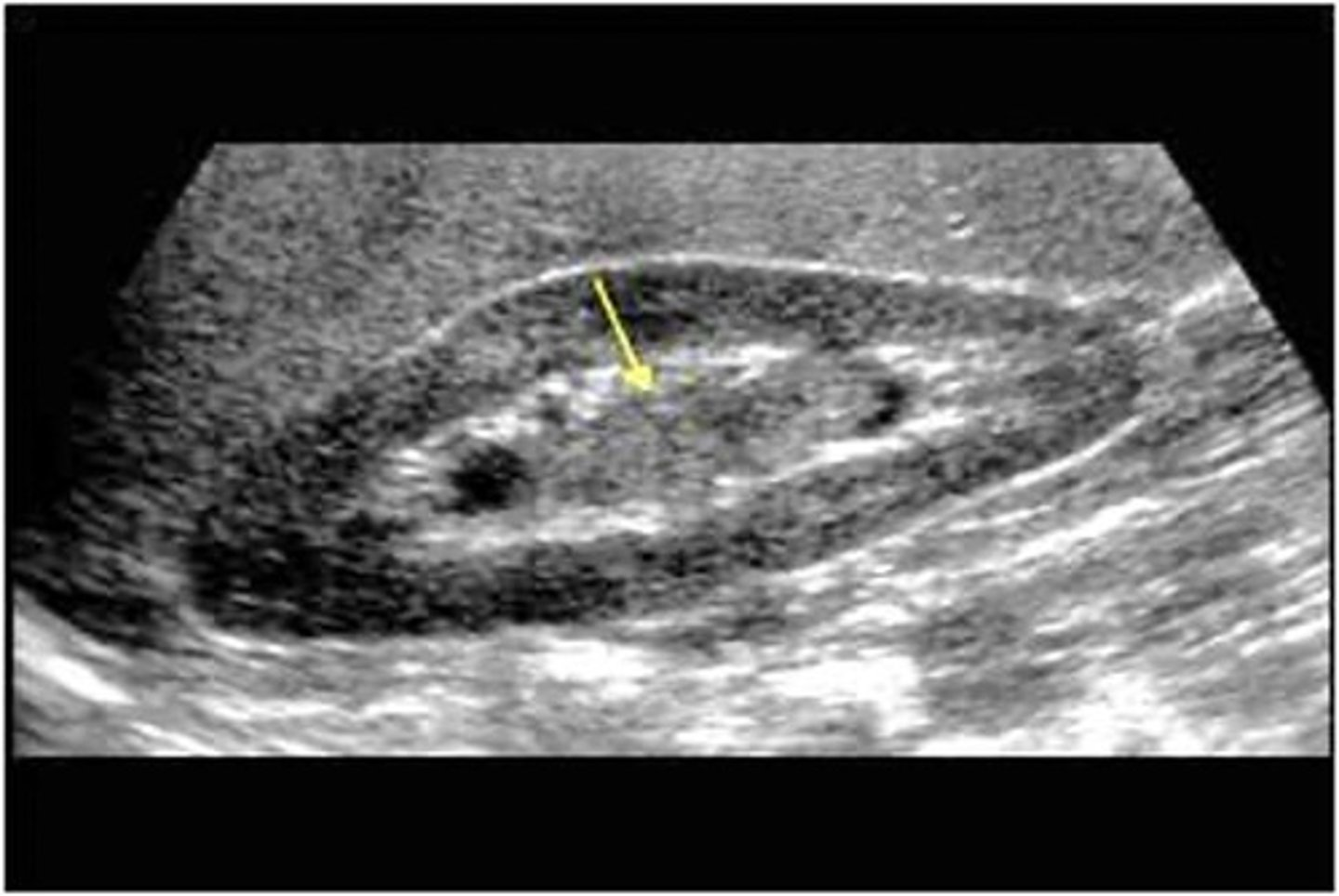 <p>Transitional cell carcinoma (TCC) is a tumor of the renal ___ </p>