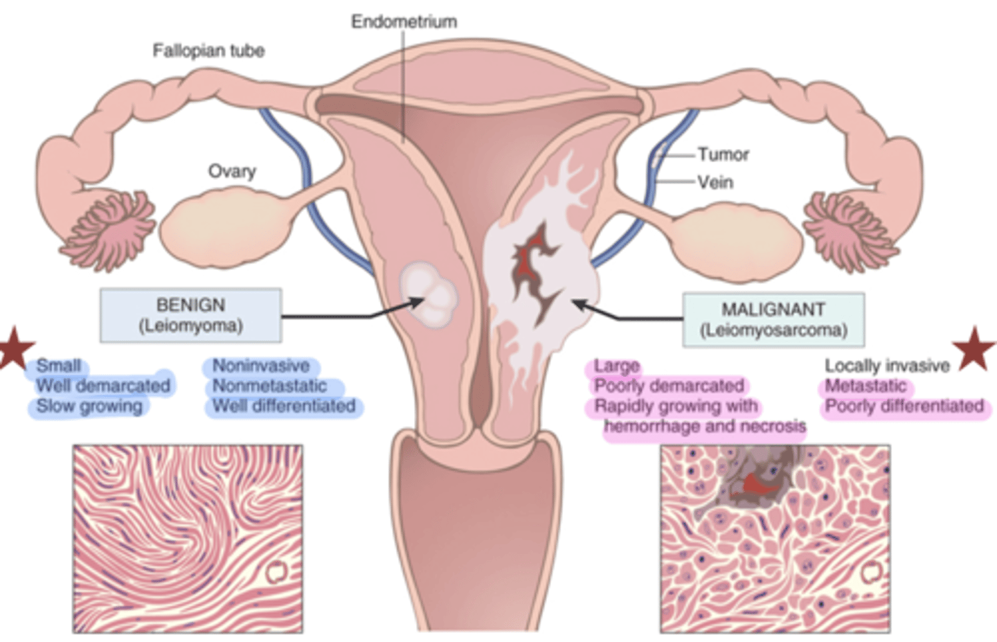 <p>• Well-differentiated</p><p>• Usually slow to divide</p><p>• Encapsulated---does not invade surrounding area</p><p>• Does not spread by metastasis</p><p>* suffix -oma (lipOMA)</p>