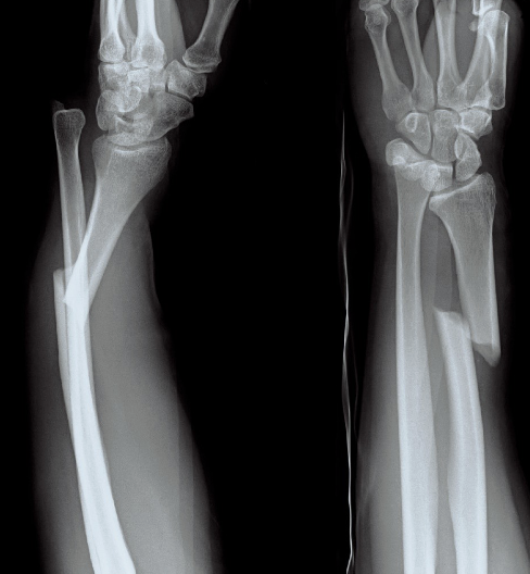 <p>Name this fracture</p>