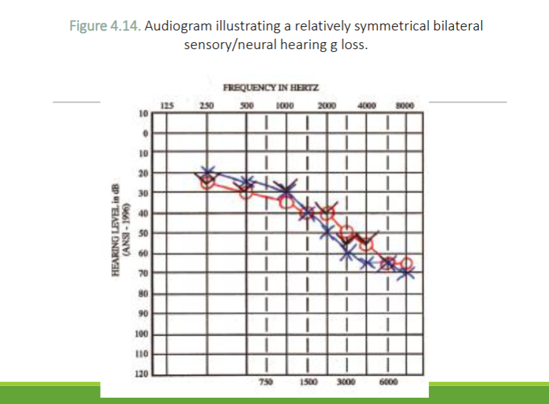 <p>What type of hearing loss is this</p>