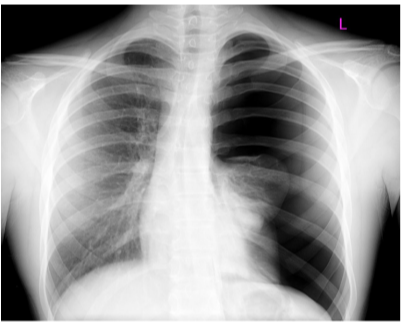 <ul><li><p>Presence of air in the pleural cavity</p><ul><li><p>Increased air pressure could cause lung collapse</p></li></ul></li><li><p>Could be due to —</p><ul><li><p>Penetrating thoracic wound</p></li><li><p>Spontaneous rupture of pulmonary bulla (spontaneous pneumothorax)</p></li><li><p>Fractured rib</p></li><li><p>Anesthetist’s needle puncturing pleura during stellate ganglion block</p></li><li><p>Making a loin incision to expose kidney</p></li><li><p>To perform adrenalctomy or to drain a subphrenic abscess</p></li></ul></li><li><p>Tension pneumothorax — condition where the ruptured tissues of thoracic wall form a valve permitting air to enter the pleural cavity upon inspiration but not allowing air to escape during expiration, thus increasing the pressure inside &amp; pushing mediastinal structures to the opposite side </p></li></ul>