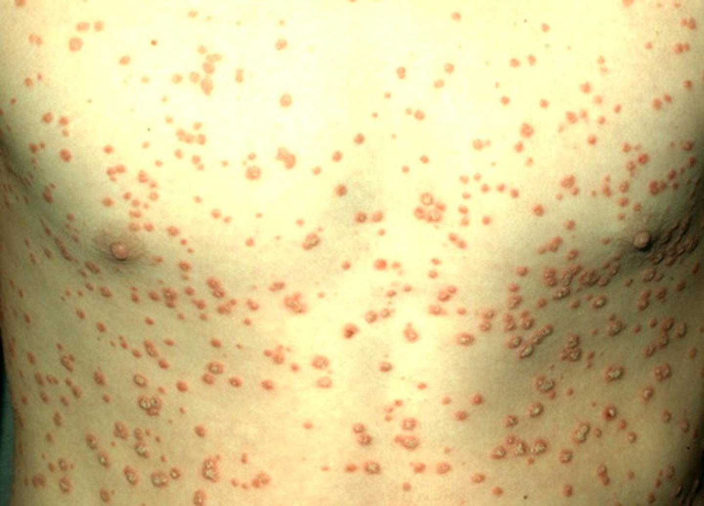 <p>Guttate psoriasis</p>