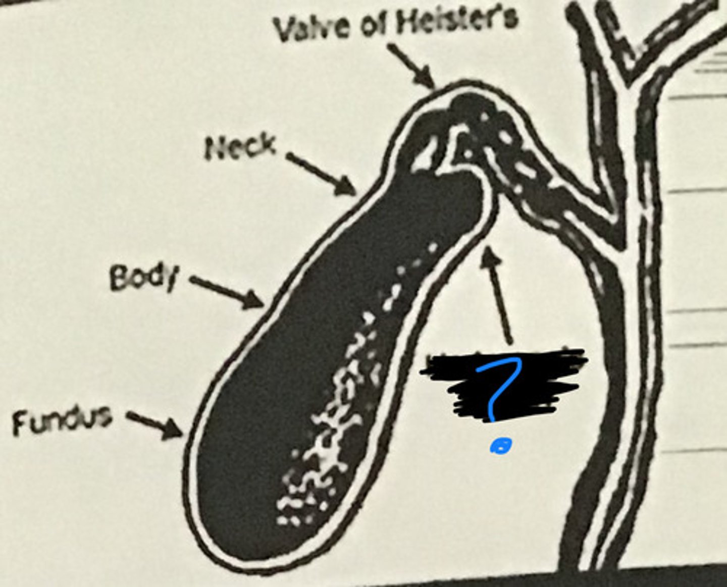 <p>Hartmann's pouch</p>