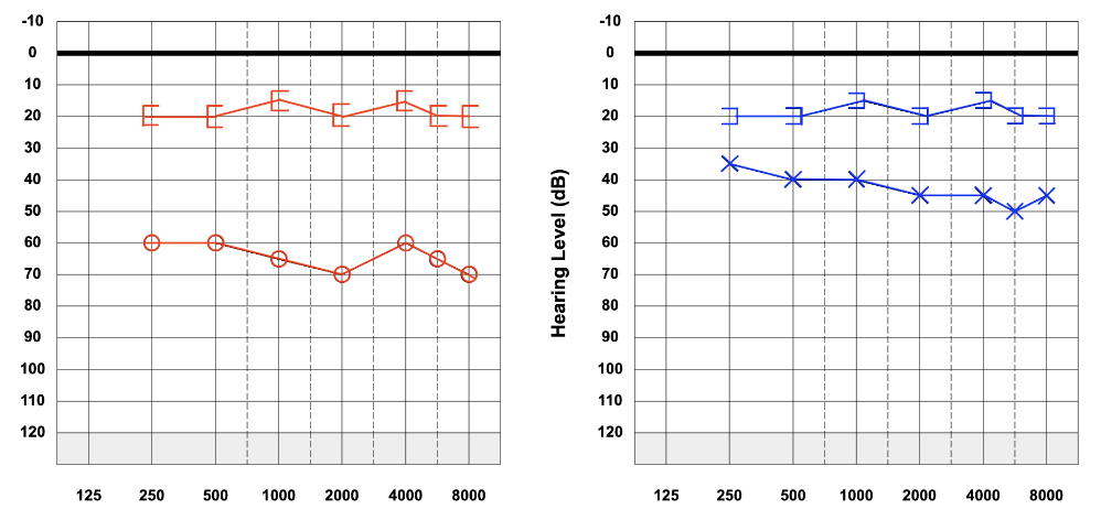 <p>What does this audiogram show?</p>