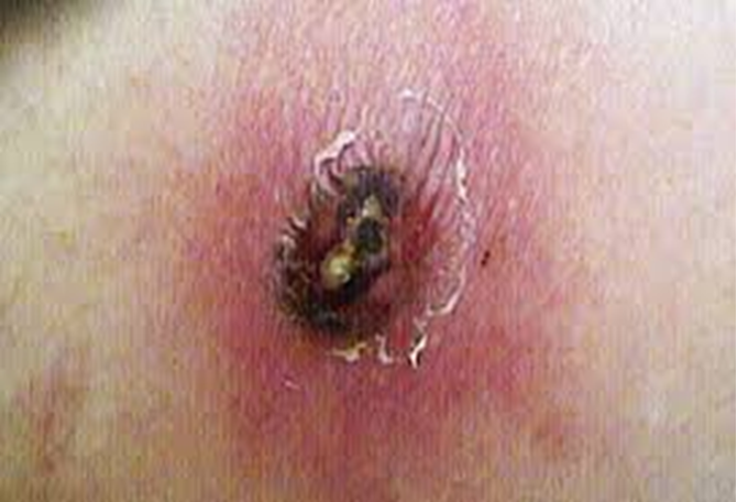 <p>Brown Recluse Spider Bite </p>