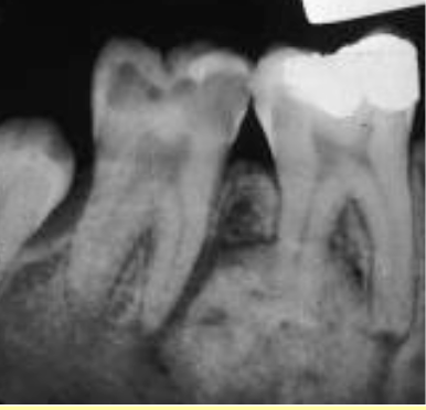 <p>Radiolucent rim is contiguous with PDL and PDL is not intact at the involved portion of the root, effacement of root</p>
