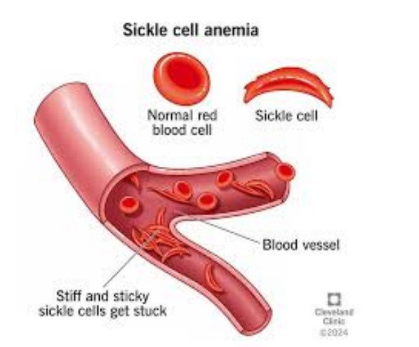 <p>Sickle Cell Anemia </p>