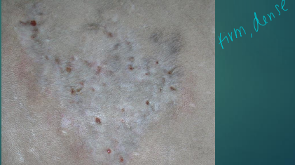 <ul><li><p><span style="color: rgb(136, 136, 136);"><strong>Et: </strong></span><strong><u>opportunistic, Gram+, partially acid-fast, filamentous aerobes; soil saprophytes;</u></strong> deep skin infection&nbsp;</p><ul><li><p>branching</p></li></ul></li><li><p><span style="color: rgb(136, 136, 136);"><strong>Sig:</strong></span><strong> </strong>2.5-11y, males</p></li><li><p><span style="color: rgb(136, 136, 136);"><strong>Cs:</strong></span> abscesses, <u>draining lesions, actinomycotic mycetoma,</u> systemic illness</p></li><li><p><span style="color: rgb(136, 136, 136);"><strong>Dt: </strong></span><strong>culture, biopsy, CBC</strong> (anemia, leukocytosis w/ L shift, hyperproteinemia)</p></li><li><p><span style="color: rgb(136, 136, 136);"><strong>Tx: </strong></span><strong>sulfonamides (1-12m)</strong></p></li></ul><p></p>