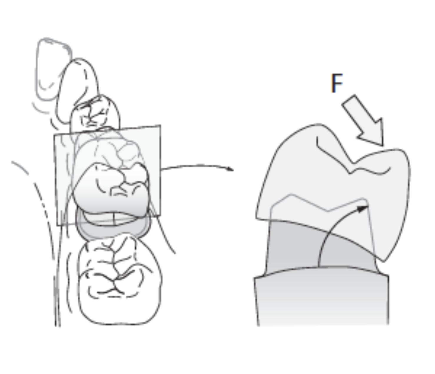<p>prevents dislodgment of the restoration by forces directed in apical or oblique direction and prevents any movement </p>