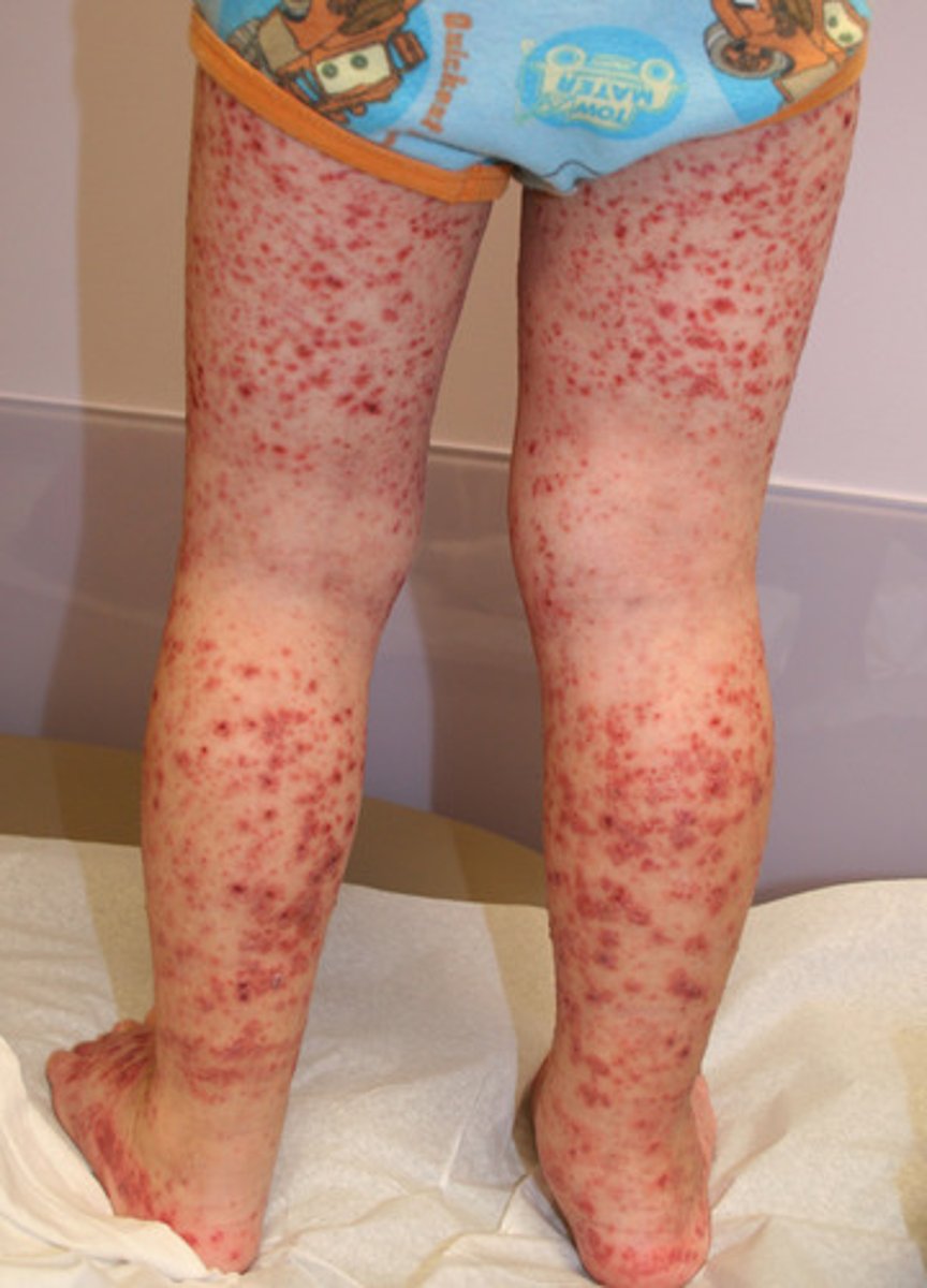 <p>damage to cutaneous vessel walls</p><p>ex. leukocytoclastic vasculitis</p>