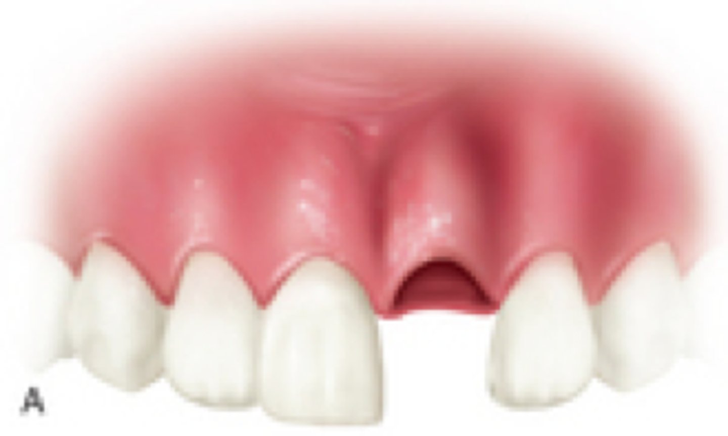 <p>tooth is completely out of the socket</p>