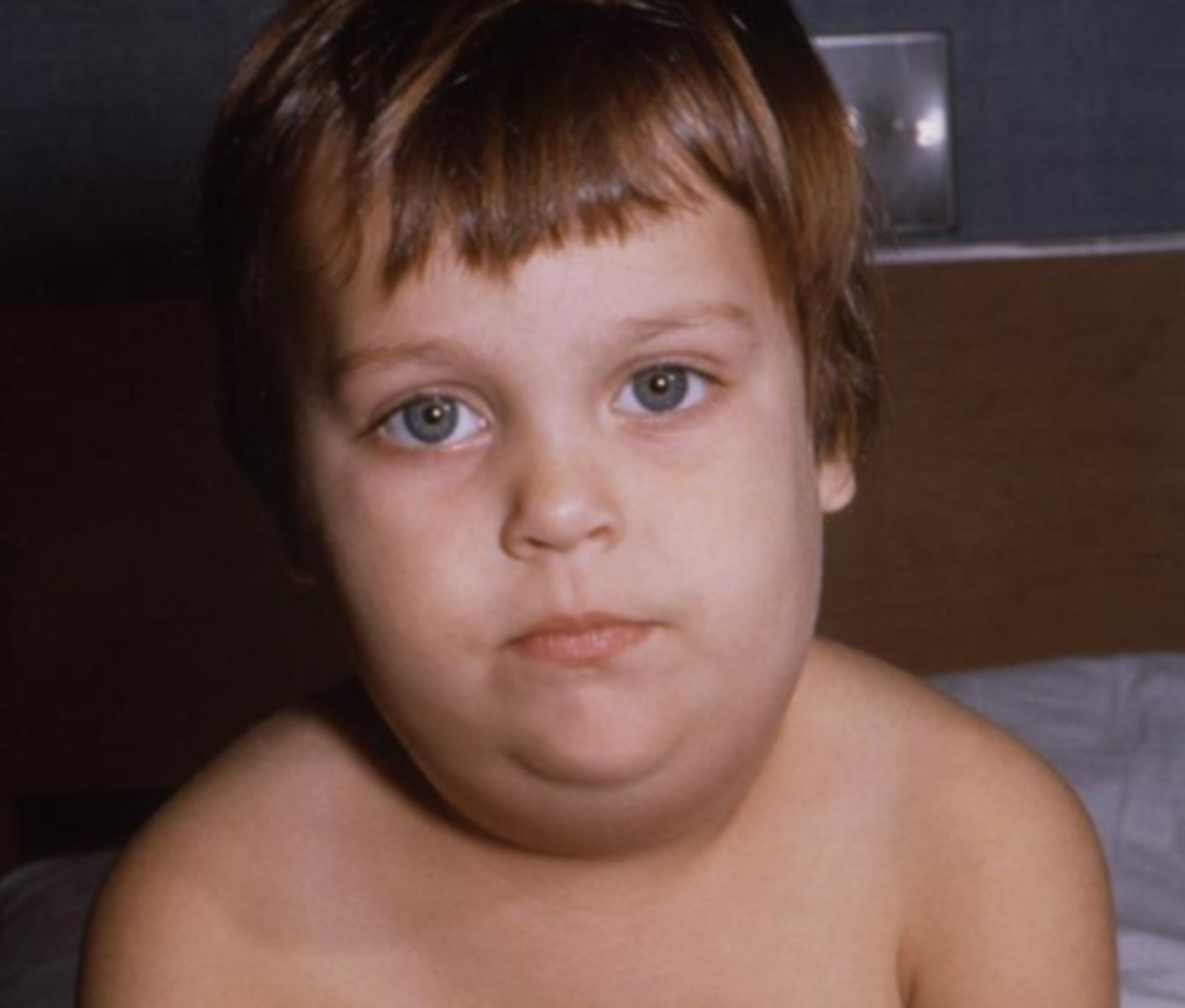 <p>viral sialadenitis</p>