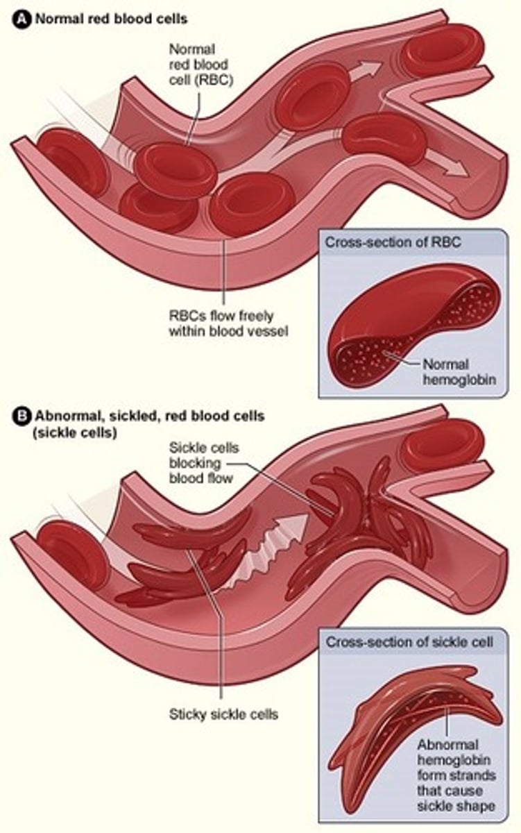 <p>Rigid sickled cells aggregate in the microvasculature<br>- hypoxia, acidosis</p>