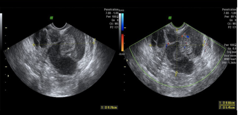 <p>a 64 yo female has left sided pain + bloating. the exam shows a 4 cm cystic mass w/numerous <strong>thick septations</strong> + small loculations that give it a <strong>honeycomb</strong> appearance. there is also a <strong>7 mm solid nodule</strong> on the lateral aspect of the cyst.</p><p>a) Brenner tumor</p><p>b) mucinous cystadenocarcinoma</p><p>c) serous cystadenocarcinoma</p><p>d) mucinous cystadenoma</p>
