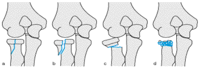 <p>Radiuskopffraktur</p>