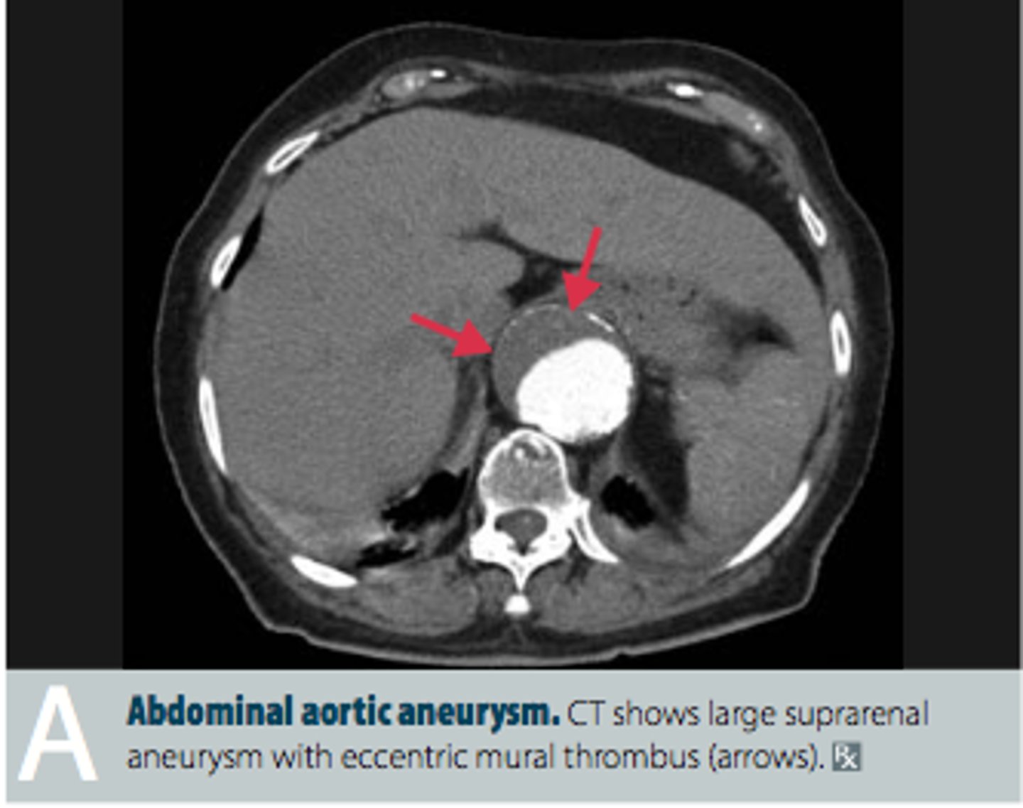 <p>localized dilation of abdominal aorta</p>