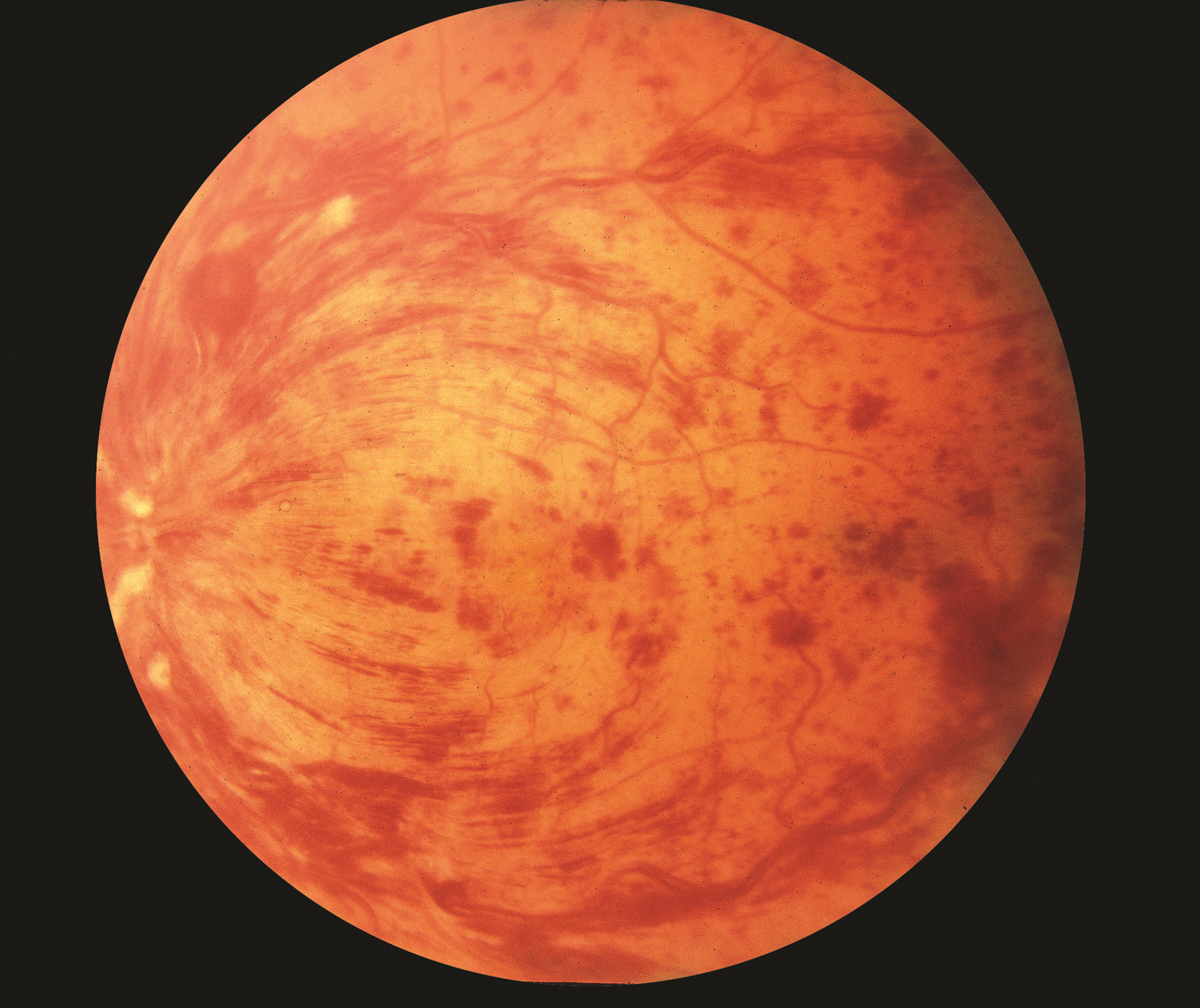 <p>Widespread hyperaemia (<strong>increase of blood flow to different tissues in the body</strong>) + severe retinal haemorrhages (stormy sunset) → sudden vision loss.</p>