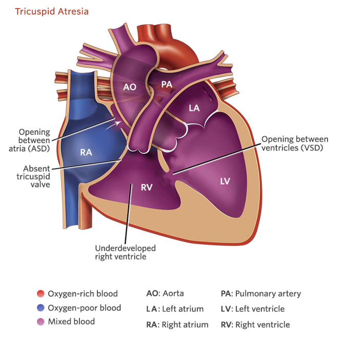 <p><strong><u>Decreased</u> Pulmonary Blood Flow</strong></p><ul><li><p class="">Tricuspid valve does not develop.</p></li><li><p class="">Blood does not go directly into the right ventricle.</p></li><li><p class="">Deoxygenated blood passes through a patent foramen ovale (PFO) in the atrial septum.</p></li><li><p class="">Blood mixing at the pulmonary artery and aorta.</p><p class="">________________________________________________________</p></li><li><p class="">Cyanosis at birth or a few days later.</p></li><li><p class="">Rapid respiration and poor feeding.</p></li><li><p class="">May have coolness and clamminess to extremities.</p></li><li><p class=""><strong><em>**Prostaglandins will be administered</em></strong> to keep the PDA open (connection between the pulmonary artery and the aorta open).</p></li></ul><p></p>
