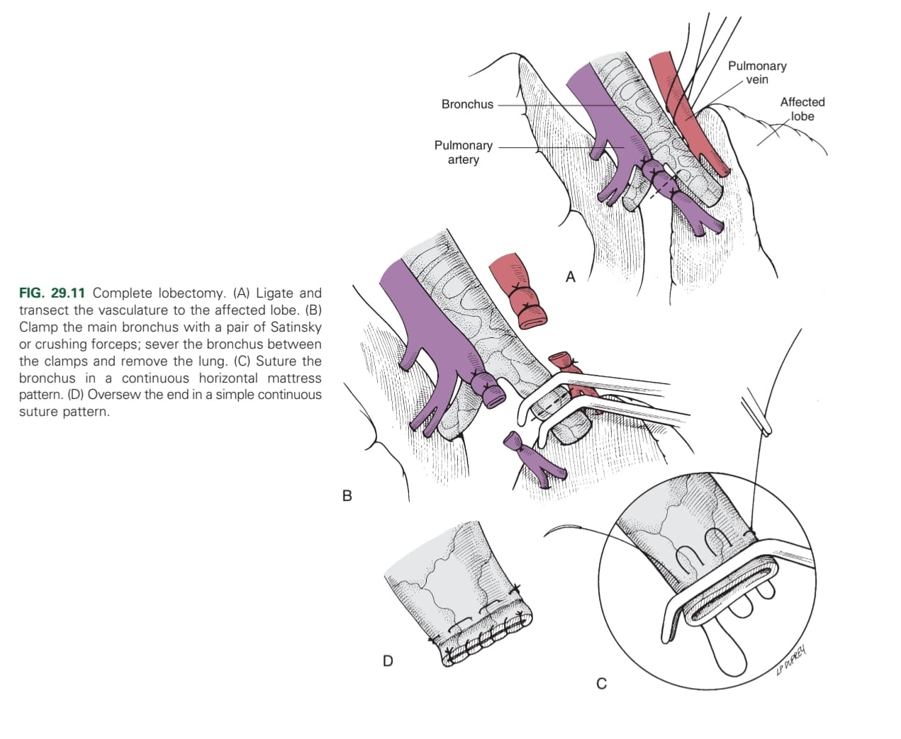 <p>1. Ligate &amp; transect the vasculature to the affected lobe</p><p>2. Clamp the main bronchus with crushing forceps</p><p>3. Sever the bronchus between the clamps &amp; remove the lung</p><p>4. Suture the bronchus in a continuous horizontal pattern</p><p>5. Over-sew the bronchus end in a simple continuous pattern</p>