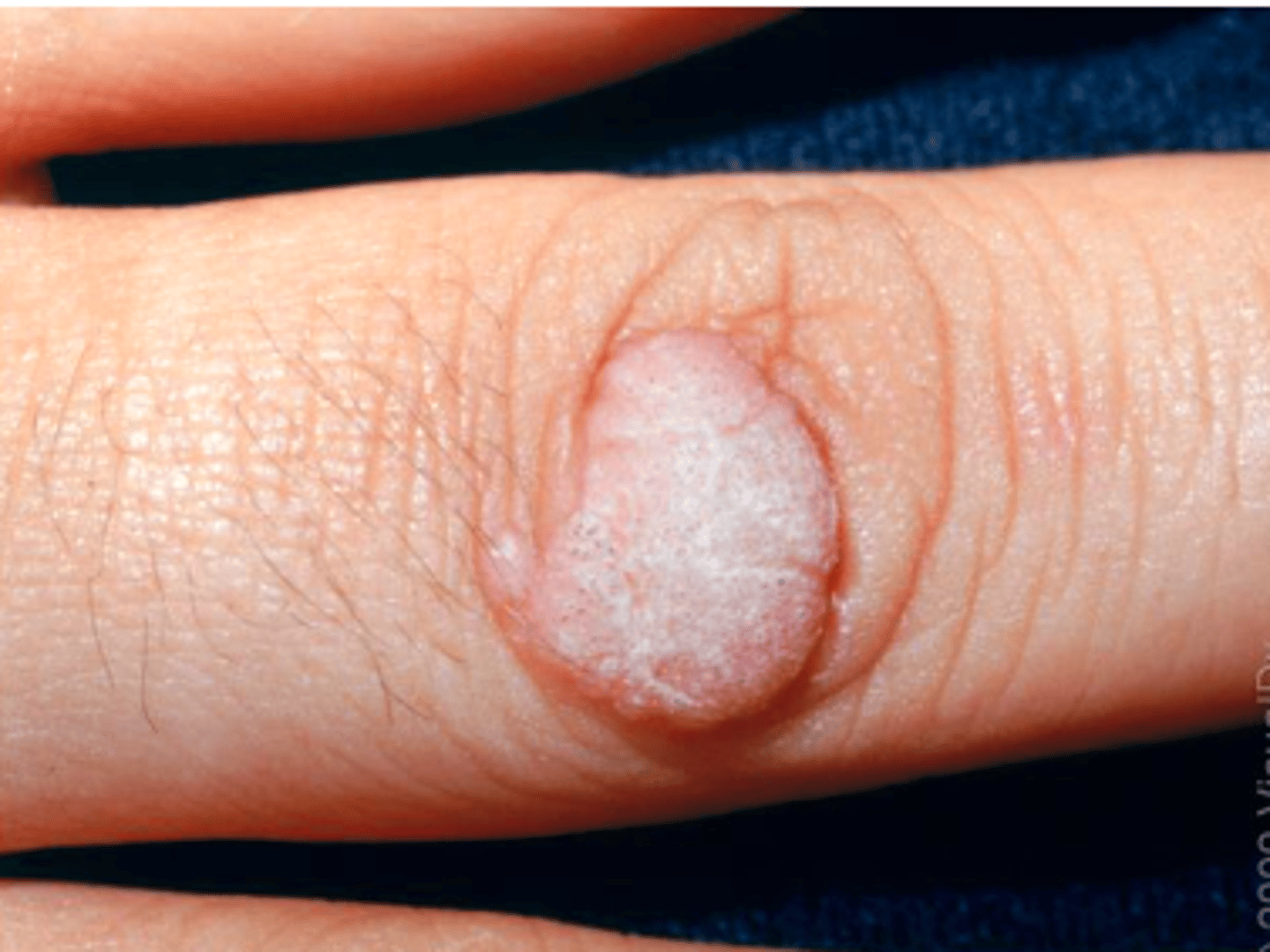 <p>HPV warts</p><p>Cancer</p>