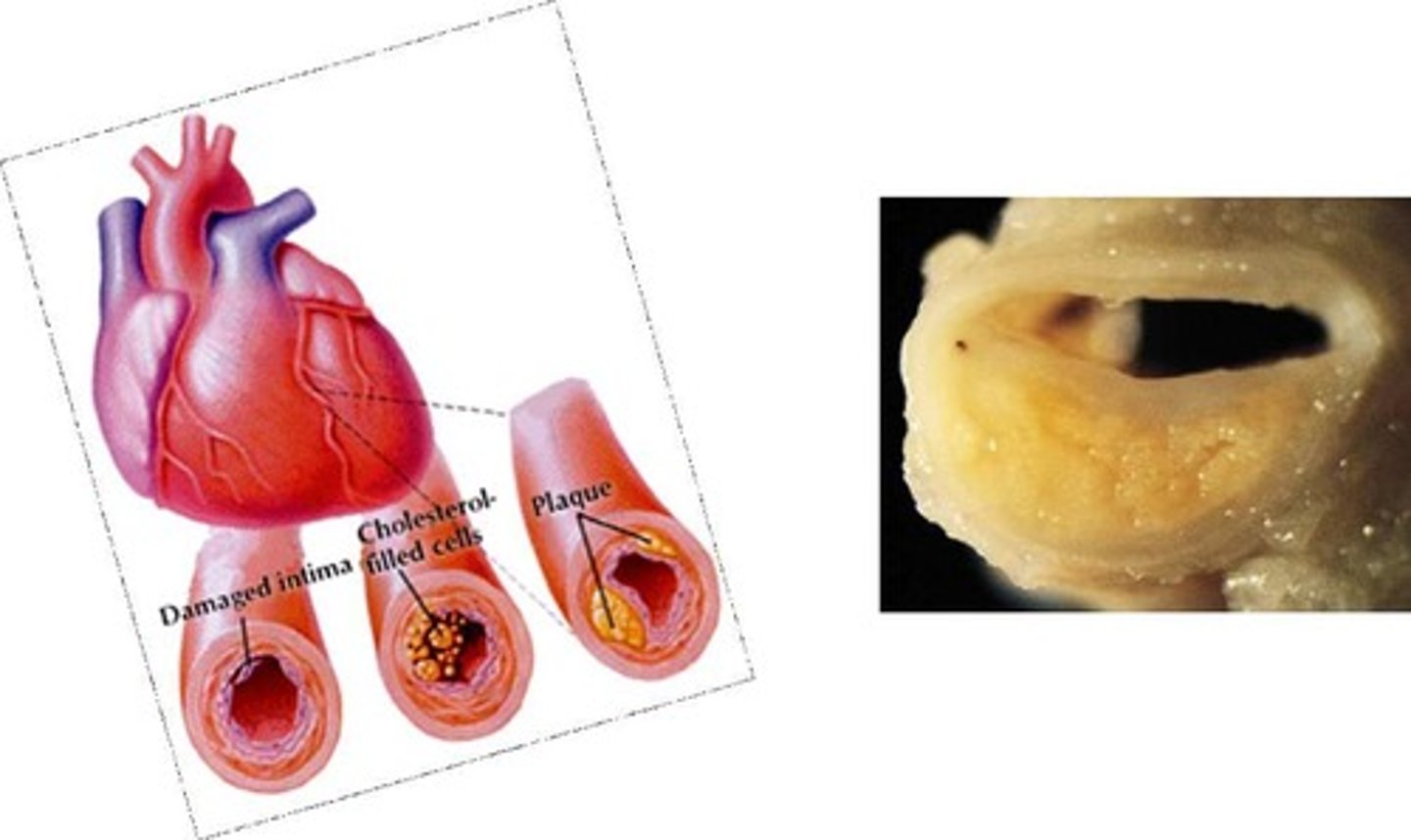 <p>A condition caused by reduced blood flow to the heart muscle, often due to atherosclerosis.</p>