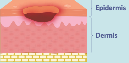 <p>what is a stage 2 pressure injury?</p>