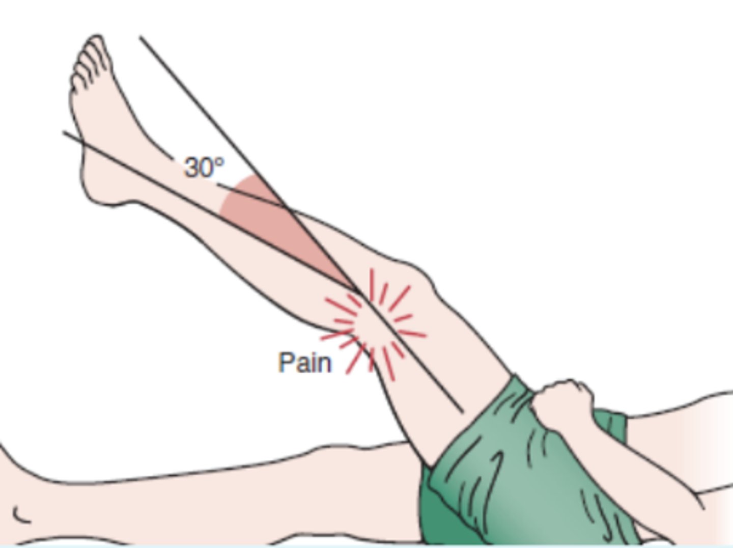 <p>- distal IT band friction syndrome</p><p>procedure:</p><p>- The patient lies in the supine position, and the examiner flexes the patient's knee to 90°, accompanied by hip flexion. Pressure is then applied to the lateral femoral epicondyle, or 1 to 2 cm (0.4 to 0.8 inch) proximal to it, with the thumb. While the pressure is maintained, the patient's knee is passively extended</p><p>(+): At approximately 30° of flexion (0° being straight leg), the patient experiences severe pain over the lateral femoral condyle</p>