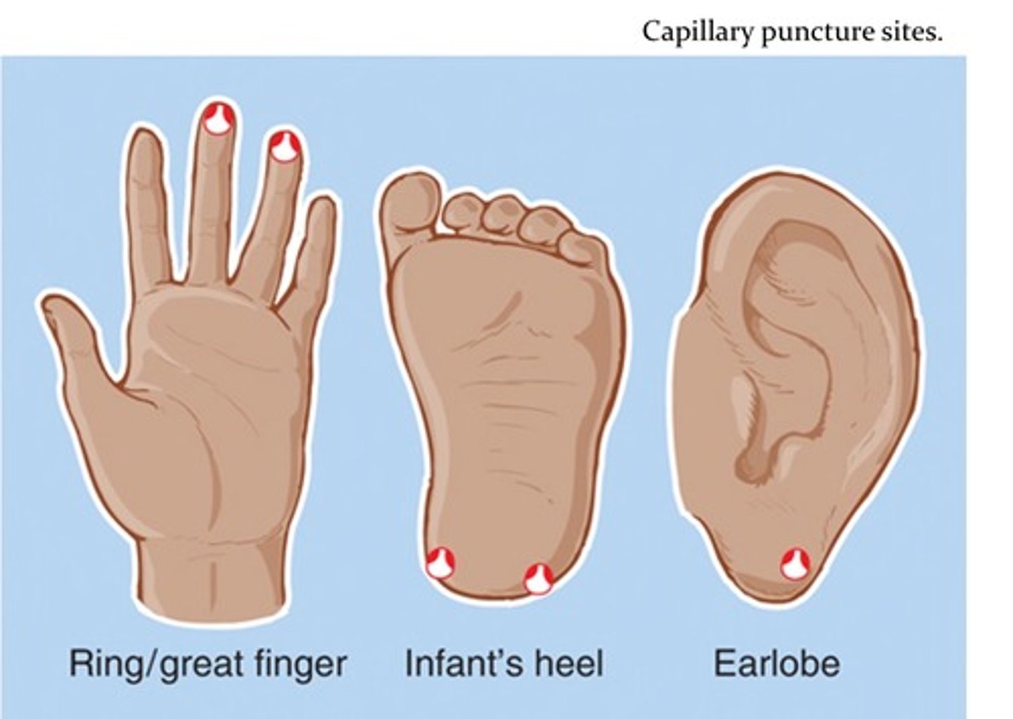 <p>B. CORRECT. The fourth digit is the preferred capillary puncture site for adults and children.</p><p>A. The fifth digit has too little tissue for a successful capillary puncture.</p><p>C. The second digit has extra nerve endings that make capillary puncture more painful.</p><p>D. The first digit is usually too callused for a successful capillary puncture.</p>