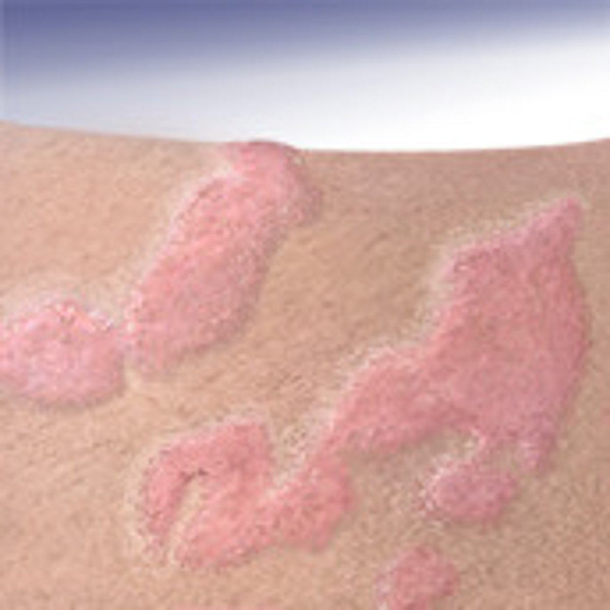 <p>hives</p>