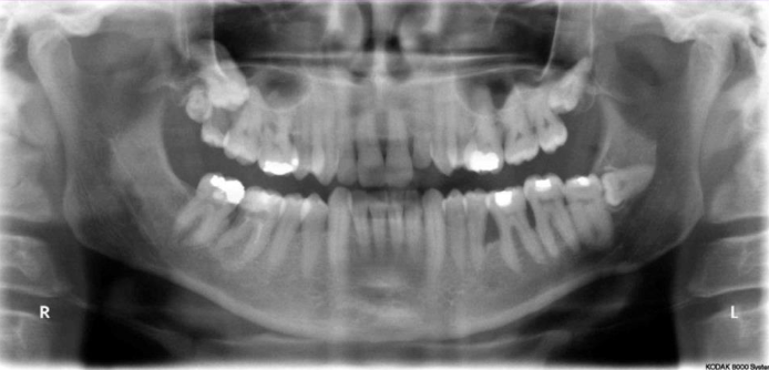 <ul><li><p>Overview of teeth and jaws in single image</p></li><li><p>Should NOT be primary imaging tool for evaluation of periodontal diseases</p><ul><li><p>Multiple superimpositions and distortions especially in anterior areas</p></li><li><p>Lower spatial resolution</p></li><li><p>Inaccurate measurements of bone loss</p></li></ul></li><li><p>NO evidence supports role for extraoral bitewing images in evaluation of periodontal bone loss</p></li></ul><p></p>