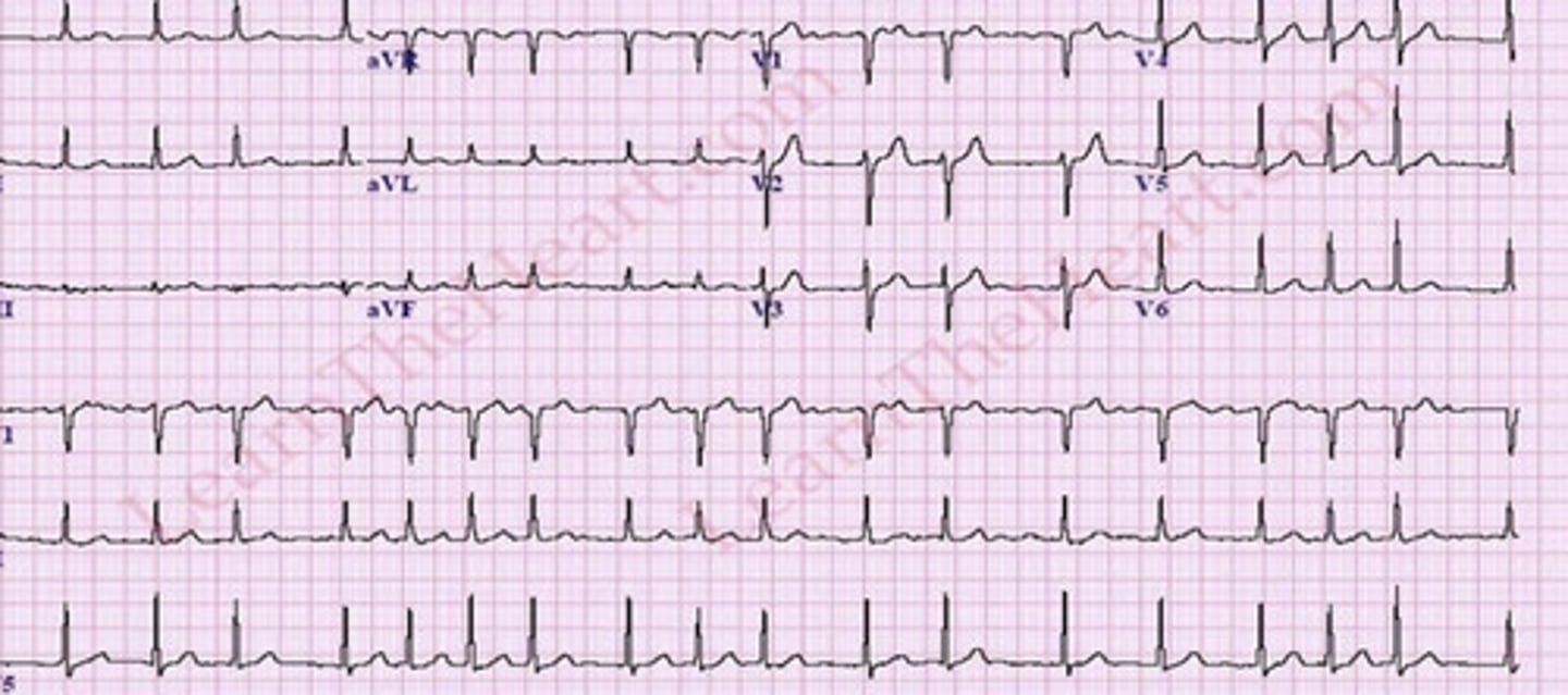 <p>A fib</p>