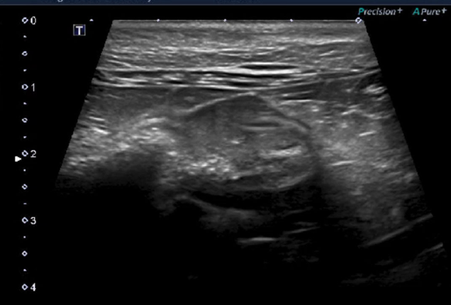 <p>intramural or intraluminal lesions, wall layering</p>