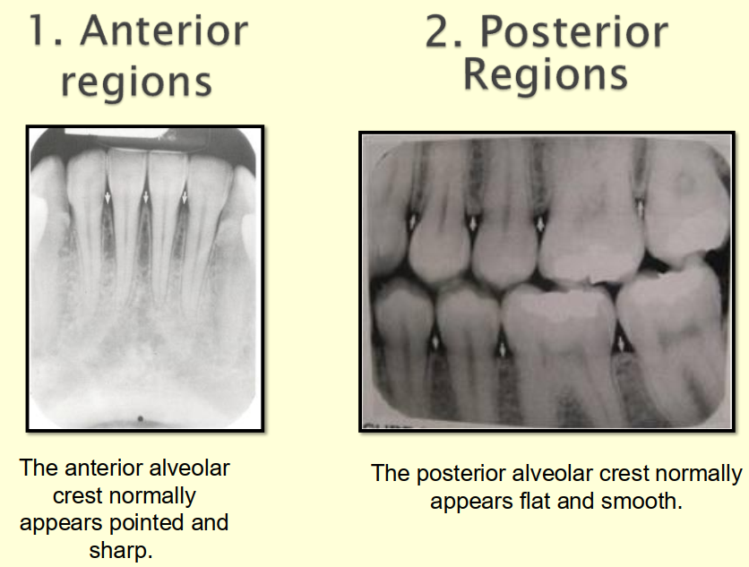 <p>Anterior alveolar bone</p><ul><li><p><strong>dense radiopaque line</strong></p></li><li><p>Appears as a thin, pointed, corticated crest between teeth.</p></li><li><p>Height is close to the CEJ line.</p></li><li><p>Interdental septa are narrow and sharp.</p></li></ul><p>Posterior alveolar bone</p><ul><li><p><strong>less dense and less radiopaque than anterior region </strong></p></li><li><p>Appears as a broader, flat, less corticated crest between teeth.</p></li><li><p>Height still follows CEJ but less sharp.</p></li><li><p>Interdental septa are wider and more rounded.</p></li></ul><p></p>