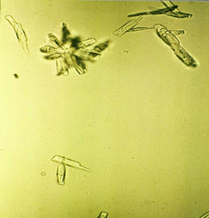 Calcium phosphate crystals in both flat and rosette form