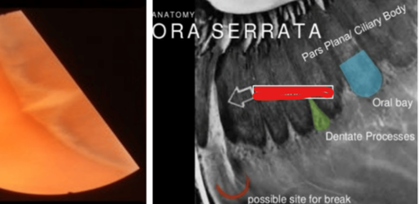 <p>permanent folding of all retinal layers oriented perpendicular to the ora serrata. Is a developmental anomaly present in 25% of the population thought to be extensions of the dentate processes. Is usually bilateral in the superior nasal quadrant, more common in males.</p>