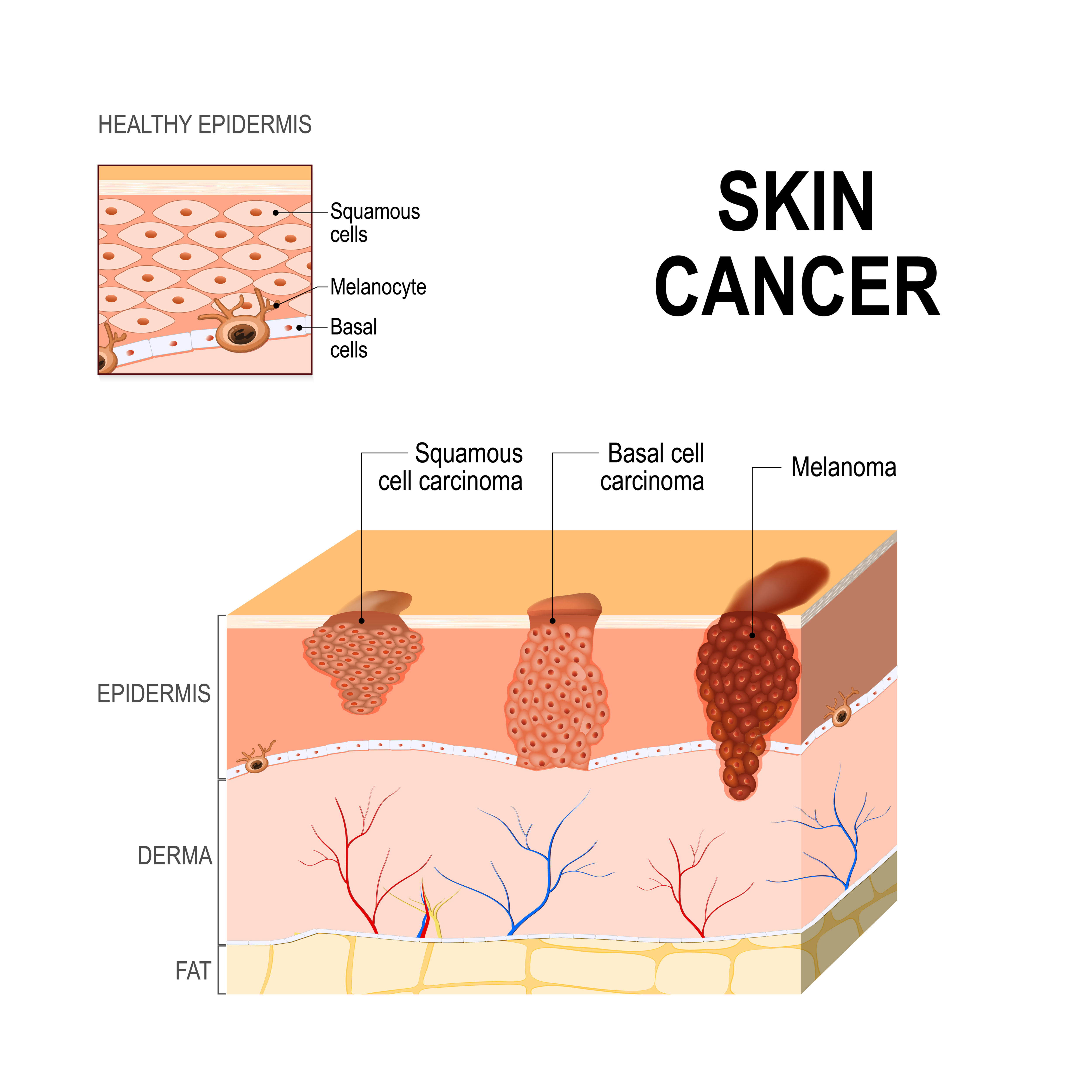 <p>False, they spread via</p><ol><li><p>Direct extension (BCC and SCC spread sideways)</p></li><li><p>Mets (Melanoma most often, SCC rare, BCC more rare)</p></li></ol><p></p>