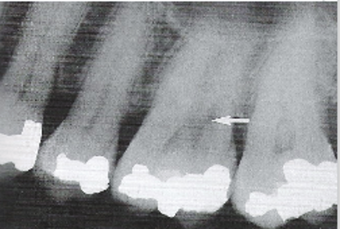 <p>-triggered by pulpal tissue reaction from within the tooth</p><p>-pulpal area is seen as a diffuse radiolucency beyond the confines of normal pulp area</p>
