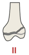 <p>Fracture running through physis and metaphysis</p>