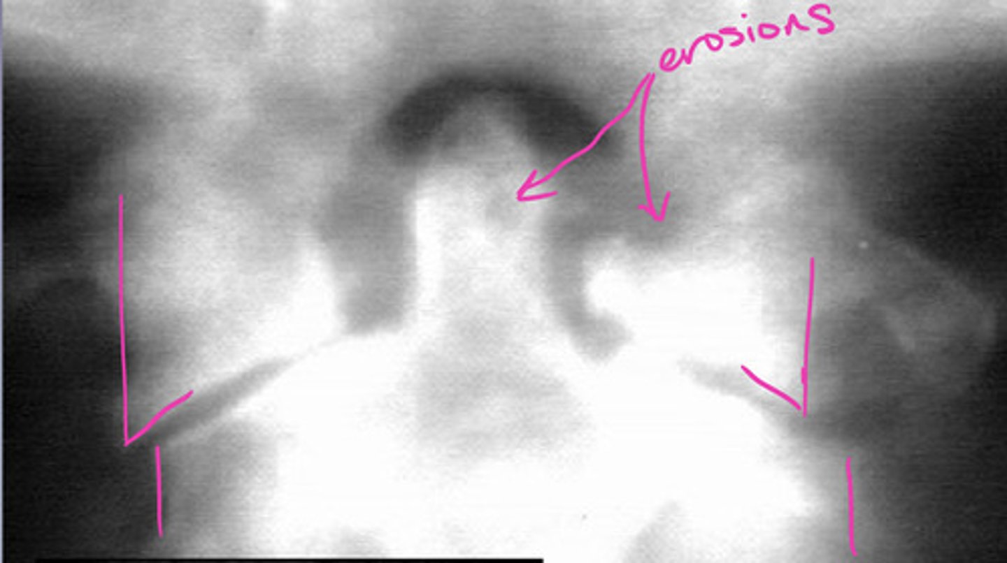 <p>Odontoid erosions could lead to "whittled dens"</p><p>Atlanto-axial impaction is the most common cause of upper cervical neurological symptoms in patients with RA</p>