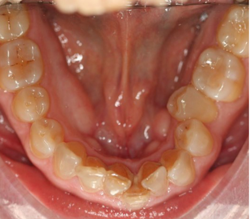 <p>18-25</p><p>Lower incisors crowding in people without previous crowding or an aggravation in patient with malocclusion</p><p>Must differentiate from relapse of treatment </p>