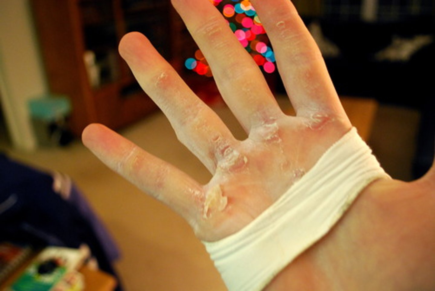 <p>area of thick hard skin at pressure points</p>