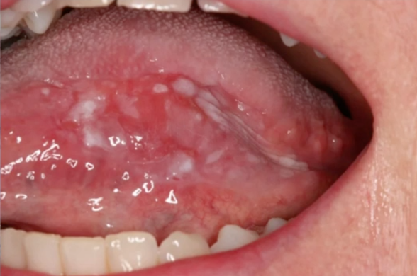 <p>what is the management of this lesion </p>