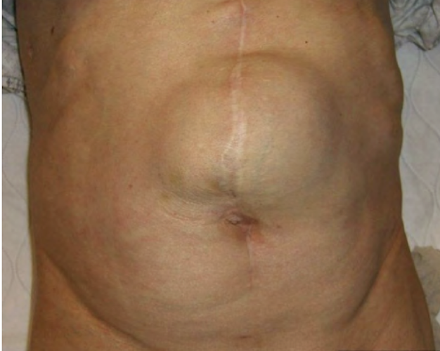<p><strong>small piece of bowel protrudes through weakness or unhealed surgical wound or weakness in abdominal wall</strong><br><em>causes:</em> improper closure, increased pressure, pregnancy prior to to healing, noncompliance with physical activity restrictions</p><p>S/S: bulge or lump near incision site, nausea/vomiting, fever, abdominal pain, constipation or diarrhea</p><p>Tx: surgical correction</p>