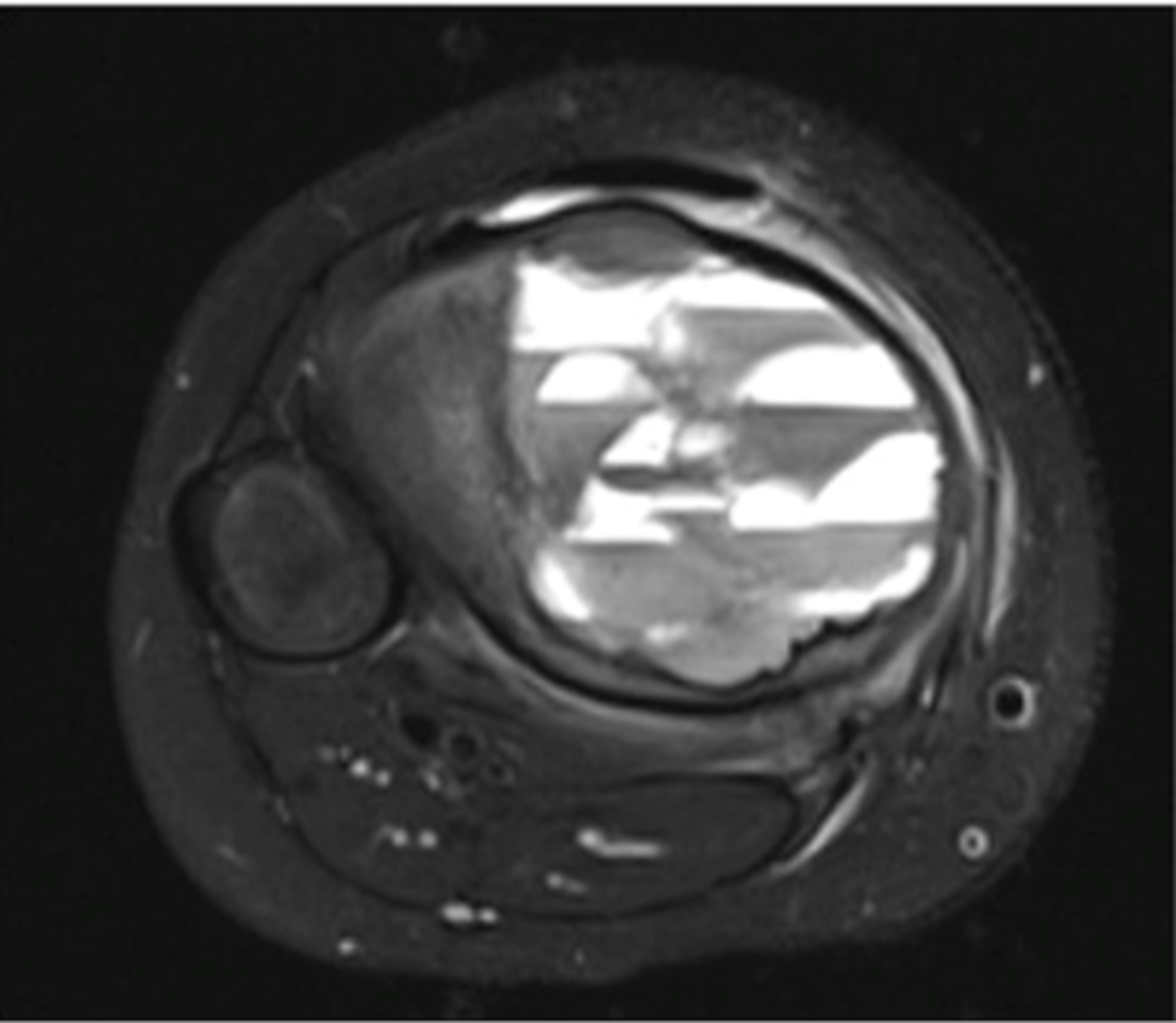 <p>- Most compatible with aneurysmal bone cyst</p><p>- Also seen in giant cell tumors, simple bone cysts, and telangiectatic osteosarcoma</p>