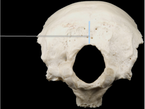 A ridge on the surface of the occipital bone. It goes vertically and crosses the inferior nuchal line