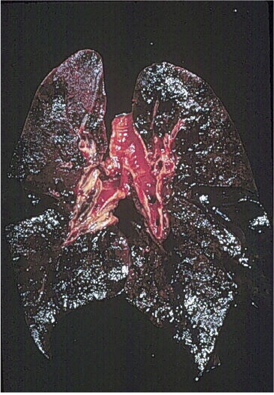 <p>What organ pathology does this image show and from what disease</p>