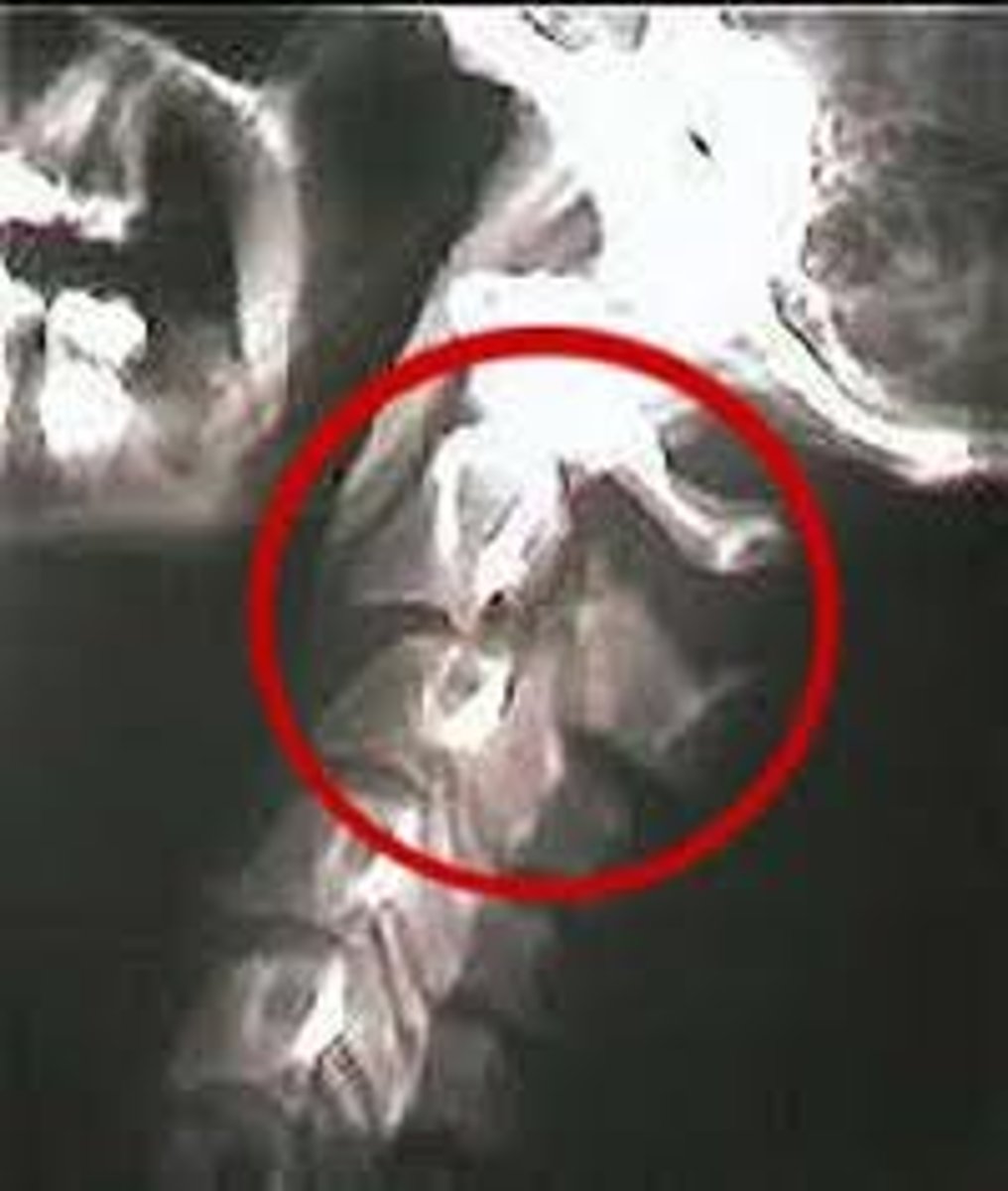 <p>- Fracture of posterior C2 (axis)</p><p>- Hyperextension of the head on the neck</p><p>- Unstable</p>